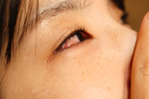 Can Allergies Cause Dry Eye? featured image