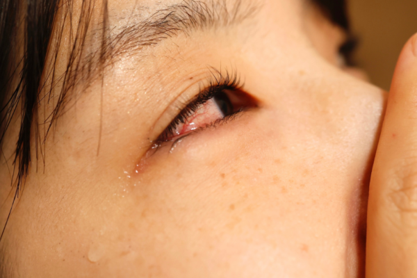 Can Allergies Cause Dry Eye? featured image