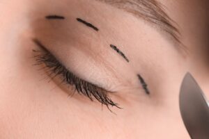 Why Trust an Ophthalmologist with Your Eyelid Surgery featured image