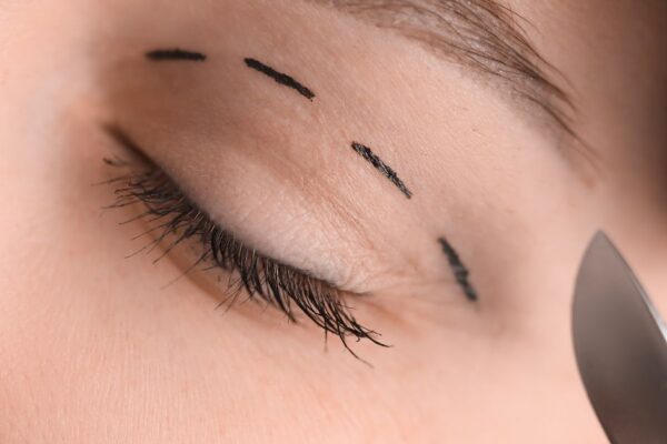 Why Trust an Ophthalmologist with Your Eyelid Surgery featured image